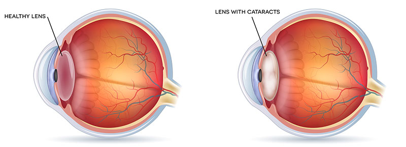 Cataracts. Human vision disorder, detailed anatomy of cataracts and healthy eye.