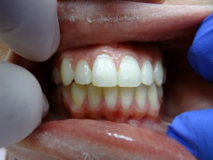 Ana after braces.