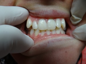 Ana before braces.
