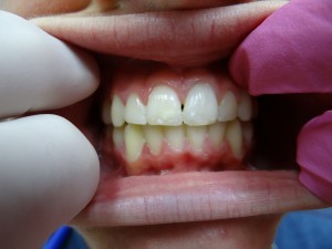 Jaxon after braces.