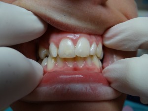 Jaxon before braces