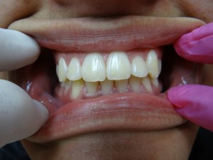 Marcos after braces.