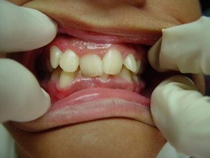 Marco before braces