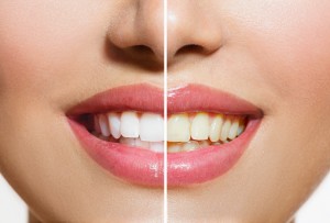 Woman Teeth Before and After Whitening. Oral Care